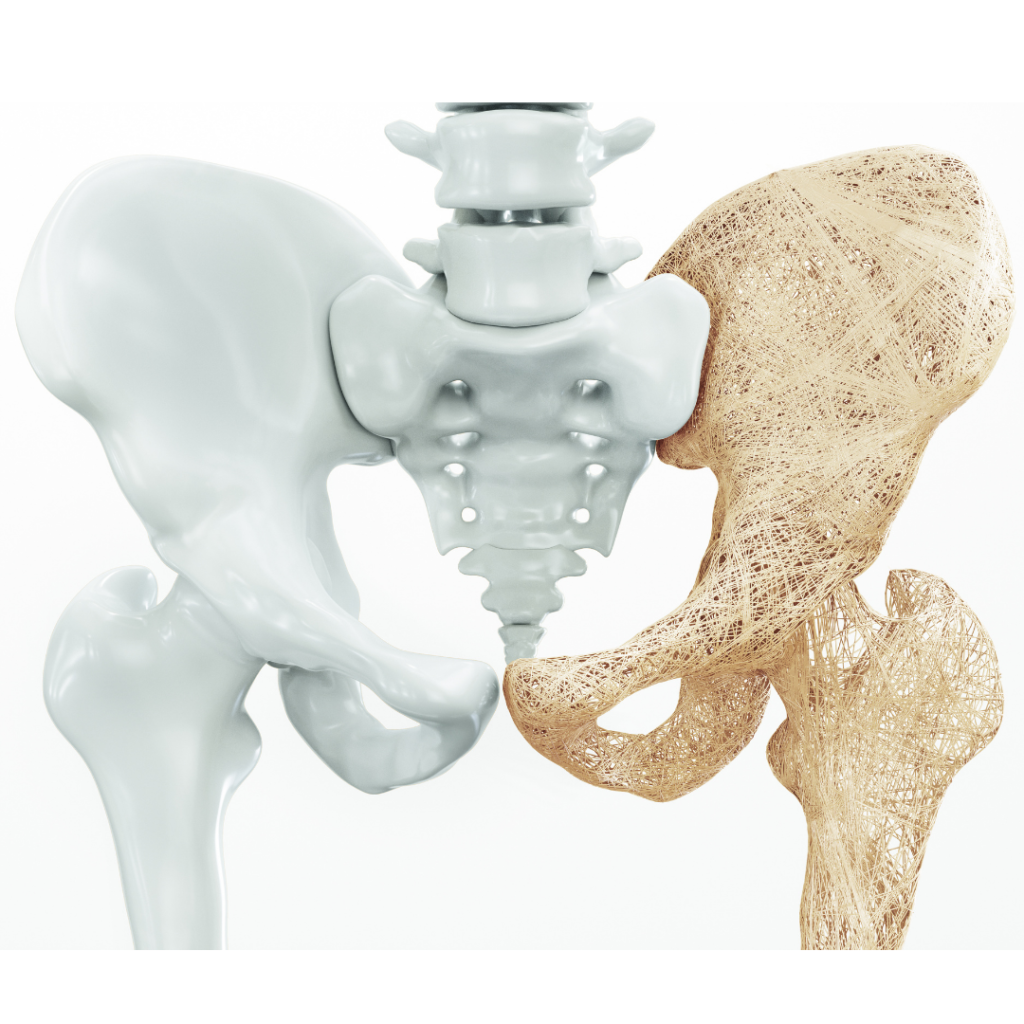 osteopenia and osteoporosis